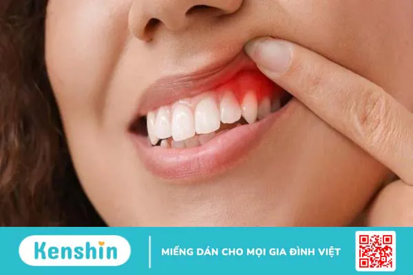 14 cách trị sưng nướu răng tại nhà đơn giản, hiệu quả bạn nên biết