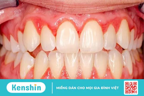 15 bệnh lý răng miệng thường gặp, nguyên nhân và cách điều trị