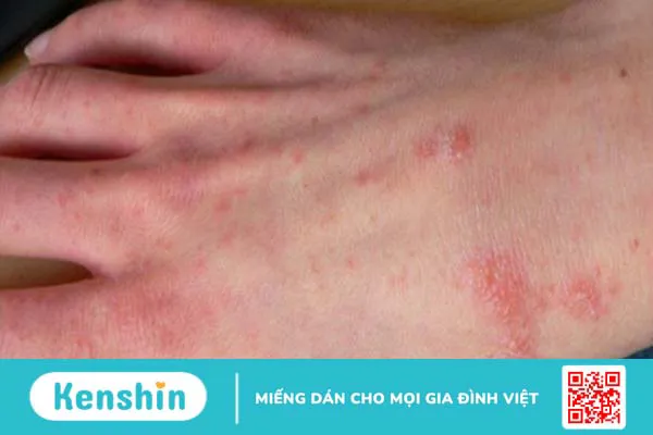 16 cách trị ghẻ ngứa tại nhà đơn giản, hiệu quả, an toàn