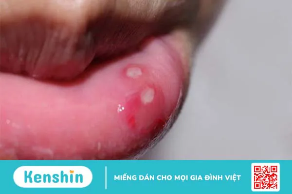 20 cách trị nhiệt miệng hiệu quả, nhanh khỏi tại nhà đơn giản, dễ làm