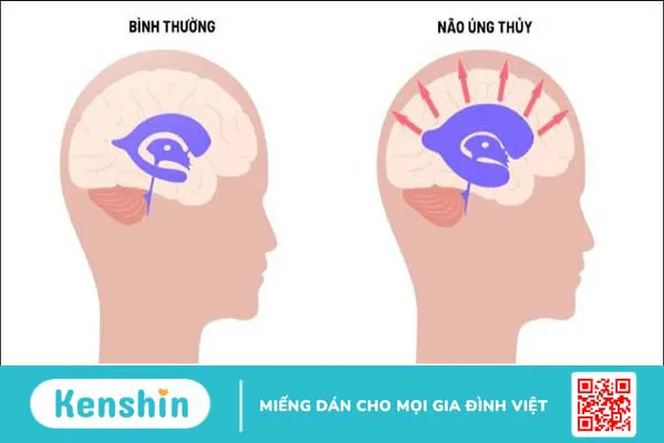 3 biến chứng não úng thuỷ thường gặp, cách điều trị và phòng ngừa