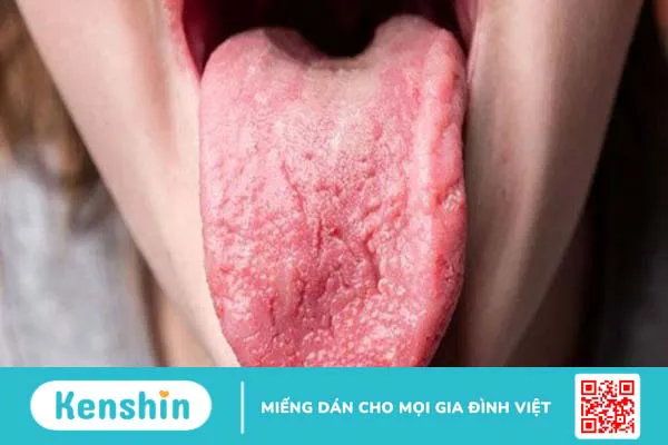 3 nguyên nhân viêm lưỡi thường gặp bạn cần biết