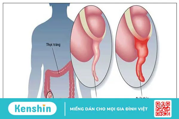 5 triệu chứng và phương pháp điều trị viêm ruột thừa cấp tính nên biết