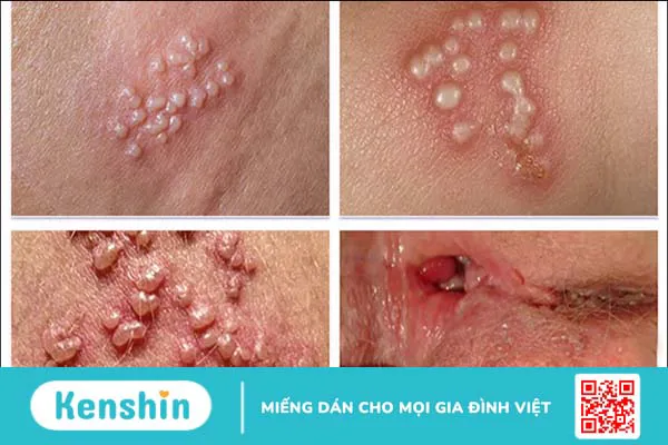 6 dấu hiệu mụn rộp (herpes) sinh dục bạn không thể bỏ qua!