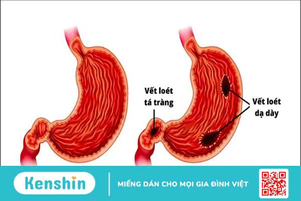 6 nhóm thuốc dạ dày hiệu quả nhất hiện nay và lưu ý khi sử dụng thuốc