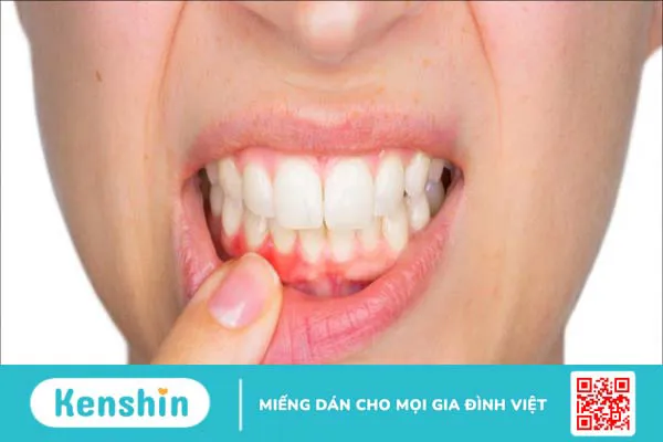 7 triệu chứng mọc răng khôn bạn cần lưu ý