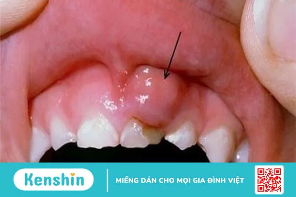 8 dấu hiệu nhận biết sớm ung thư nướu răng và cách điều trị