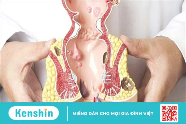 8 nguyên nhân đi cầu ra máu và cách điều trị, lưu ý cần biết