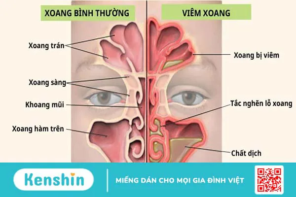 8 triệu chứng viêm xoang giúp bạn nhận biết bệnh nhanh chóng