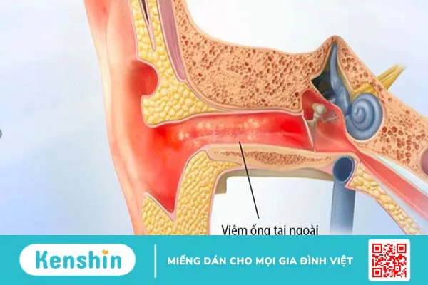 9 cách chữa viêm tai ngoài đơn giản tại nhà an toàn và hiệu quả