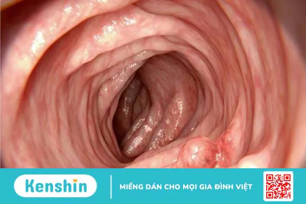 9 dấu hiệu ung thư đại tràng giai đoạn 1 bạn không nên chủ quan