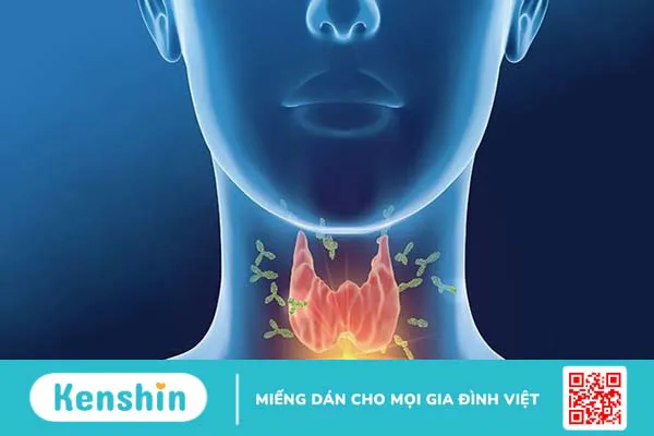 9 nguyên nhân gây bệnh suy giáp bạn nên biết