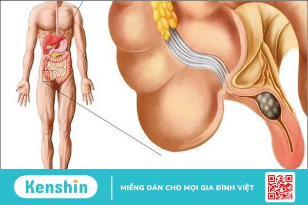 9 nguyên nhân viêm ruột thừa điển hình bạn cần phải lưu ý