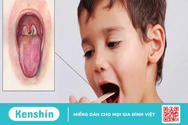 Bạch hầu là bệnh nguy hiểm, không nên chủ quan