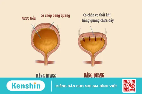 Bàng quang tăng hoạt nên ăn gì? 7 loại thực phẩm tốt cho bàng quang