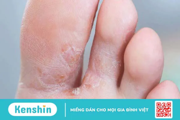 Bệnh nấm kẽ chân (nước ăn chân) – bệnh thường gặp mùa mưa bạn cần biết