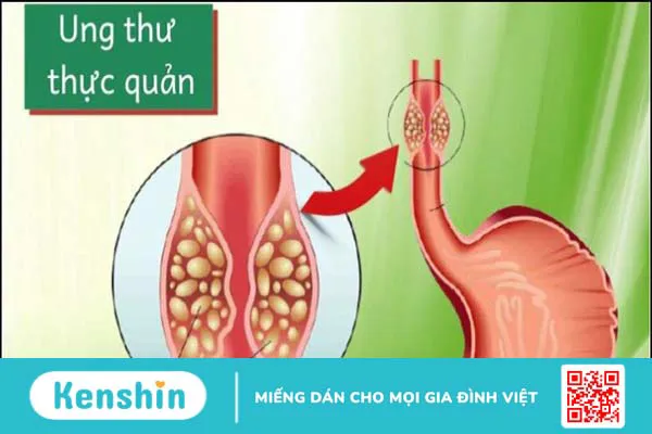 Bệnh nhân ung thư thực quản sống được bao lâu? Phương pháp điều trị