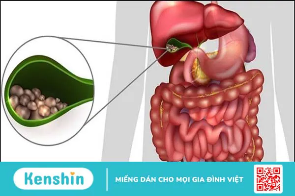 Bệnh sỏi mật nên kiêng gì và ăn gì? Lưu ý trong chế độ ăn