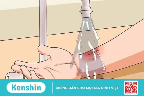 Bị bỏng nên làm gì? 12 mẹo trị phỏng nước sôi, bỏng lửa hiệu quả