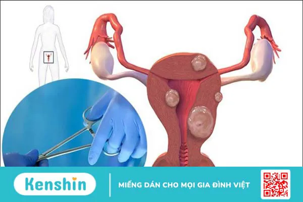 Biến chứng sau khi mổ u xơ tử cung là gì? 9 biến chứng có thể gặp