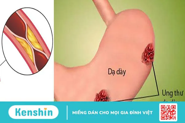 Các phương pháp điều trị ung thư dạ dày tiên tiến