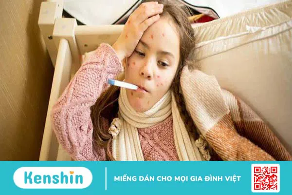 Cách chăm sóc bệnh nhân thủy đậu hiệu quả, không để lại sẹo