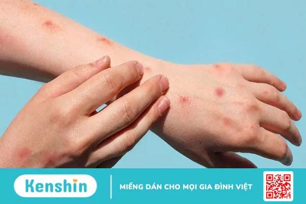 Cách chữa bệnh đậu mùa khỉ theo hướng dẫn của Bộ Y tế và chẩn đoán