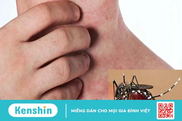 Cách phân biệt sốt xuất huyết với sốt thông thường