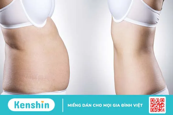 Cách xác định vị trí có mỡ thừa trên cơ thể