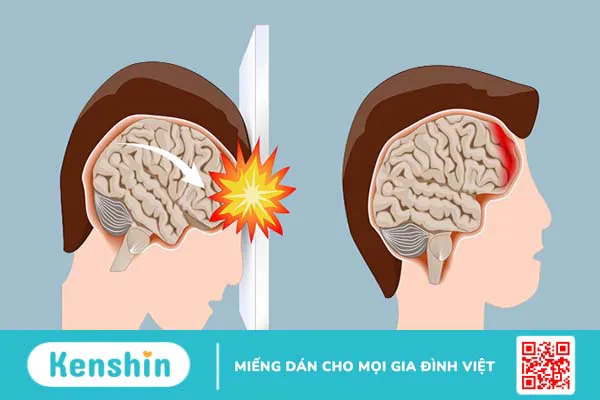 Cảnh báo 13 nguyên nhân xuất huyết não bạn không nên chủ quan