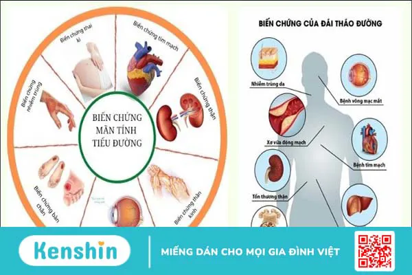 Chăm sóc bệnh nhân tiểu đường trong mùa dịch Covid-19 tại nhà