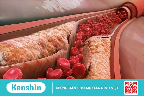 Cholesterol là gì? Có mấy loại cholesterol?