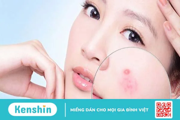 Có nên sử dụng giấm tạo trị sẹo mụn không?