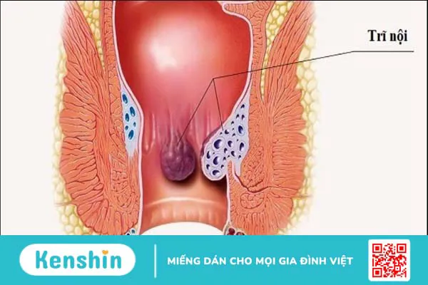 Dấu hiệu bệnh trĩ ở phụ nữ và cách điều trị hiệu quả