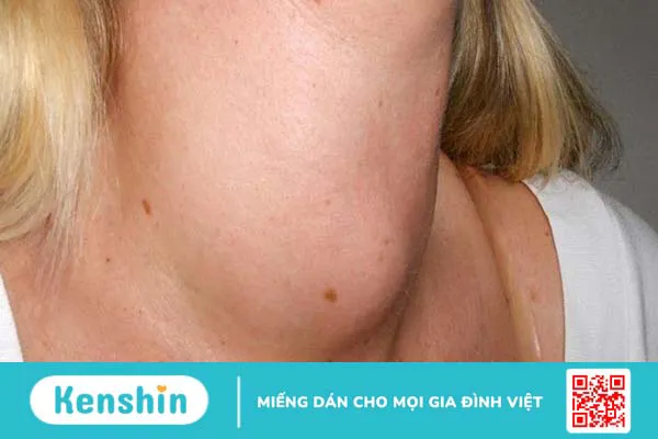 Dấu hiệu ung thư vòm họng giúp bạn nhận biết bệnh nhanh và chính xác