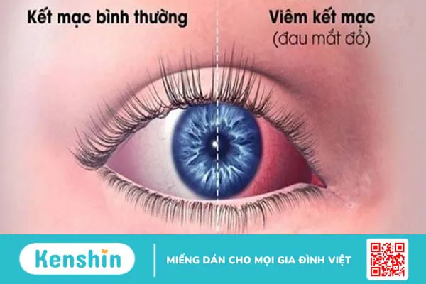 Đau mắt đỏ bao lâu thì khỏi? Cách điều trị và phòng ngừa tái phát