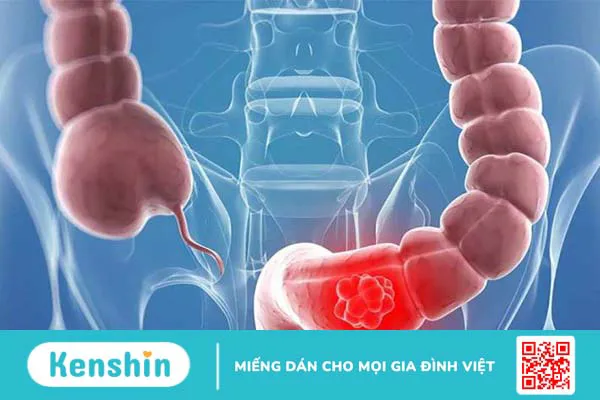 Enterogermina có trị táo bón không? Cách sử dụng men hiệu quả