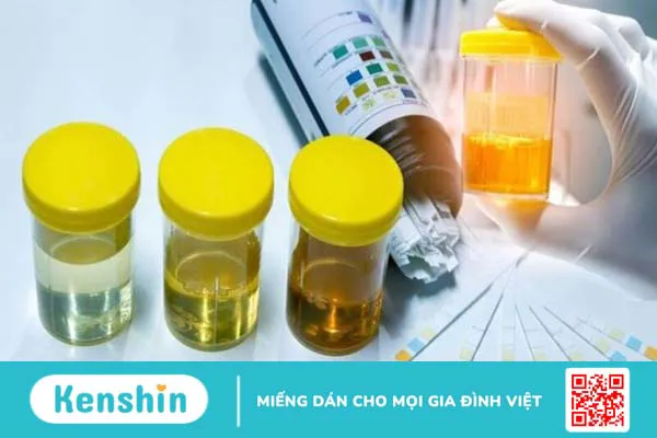 Hướng dẫn đọc các chỉ số xét nghiệm của nước tiểu bạn cần biết