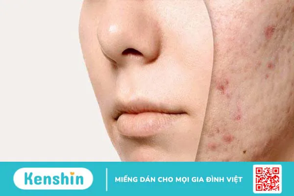 Mụn ẩn là gì? 14 cách trị mụn ẩn an toàn, hiệu quả và cách ngăn ngừa