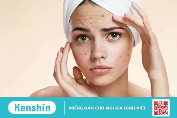 Mụn trứng cá ở tuổi dậy thì