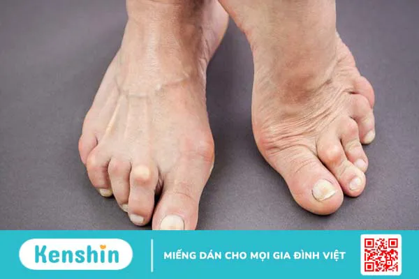 Người bệnh viêm khớp dạng thấp kiêng ăn gì để tốt cho xương