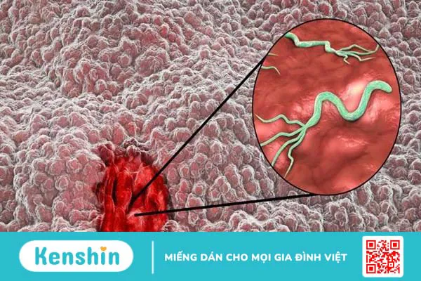 Nguyên nhân viêm loét dạ dày có thể bạn đang gặp phải