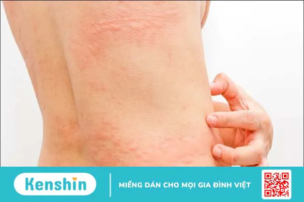 Nổi mề đay kiêng gì? Nên ăn gì và lưu ý giúp giảm ngứa, mau lành