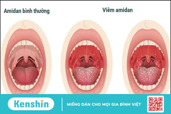 Phân biệt viêm họng và ung thư vòm họng qua 6 điều sau