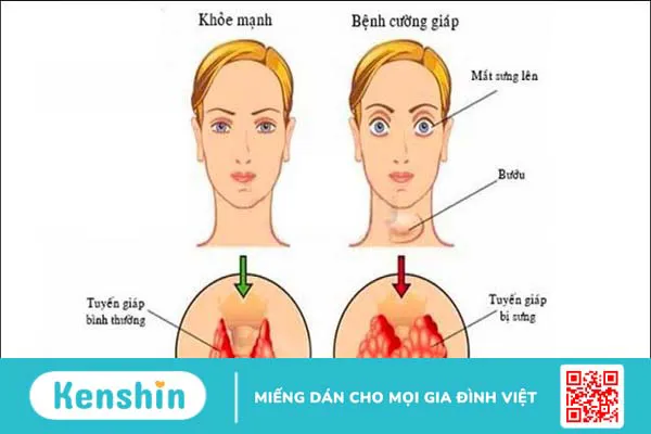 Phương pháp điều trị cường giáp bạn nên biết