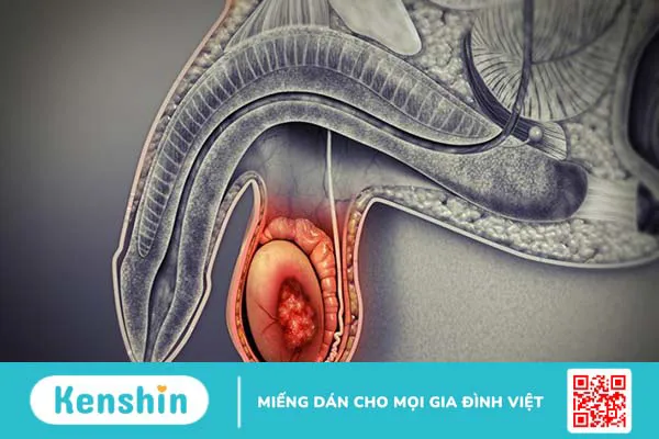 Phương pháp điều trị ung thư tinh hoàn bạn nên biết