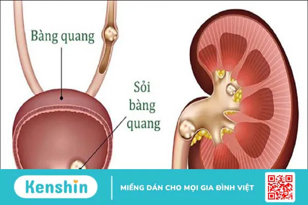 Sỏi bàng quang: 11 nguyên nhân gây bệnh không thể chủ quan