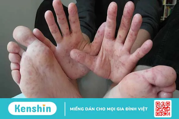 Tay chân miệng có để lại sẹo không? Cách chăm sóc đúng cho trẻ