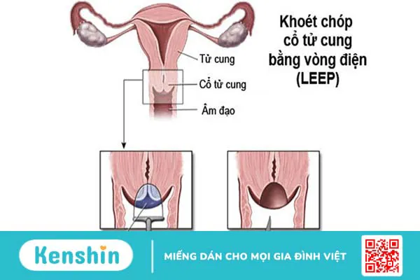 Thủ thuật LEEP điều trị viêm cổ tử cung