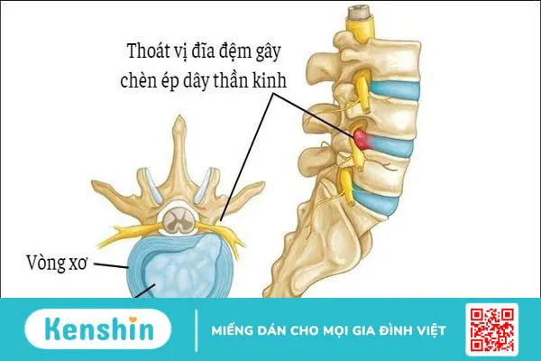 Top 12 bài tập thoát vị đĩa đệm tại nhà hiệu quả nhất và lưu ý khi tập